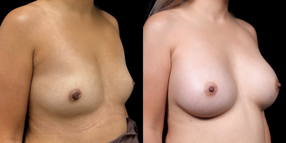 Breast Augmentation Before & After Gallery - Patient 278629 - Image 2
