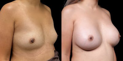 Breast Augmentation Before & After Gallery - Patient 278629 - Image 2