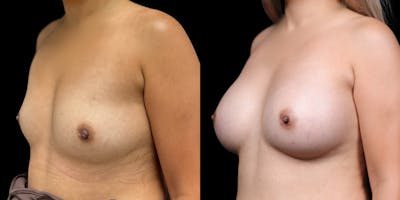 Breast Augmentation Before & After Gallery - Patient 278629 - Image 4