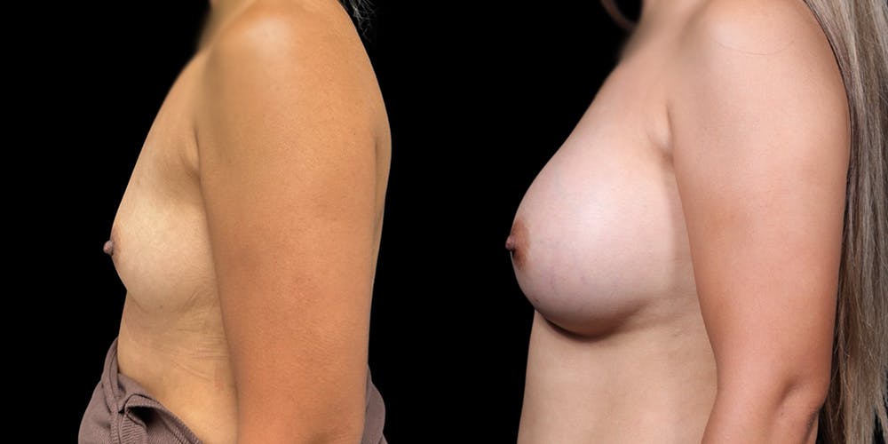 Breast Augmentation Before & After Gallery - Patient 278629 - Image 5