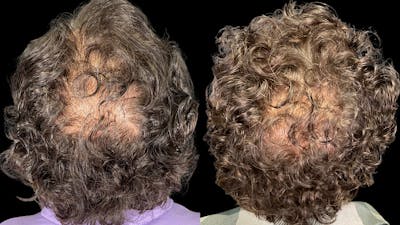 Hair Restoration Before & After Gallery - Patient 233815 - Image 2