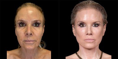 Fat Grafting Before & After Gallery - Patient 155766 - Image 1