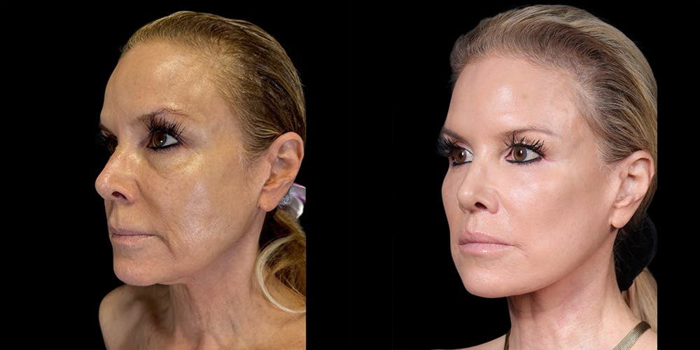 Fat Grafting Before & After Gallery - Patient 155766 - Image 4