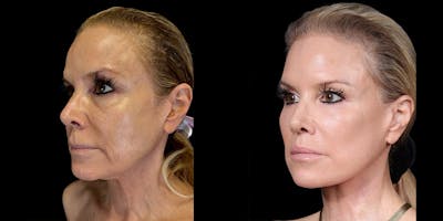 Necklift Before & After Gallery - Patient 138120 - Image 1