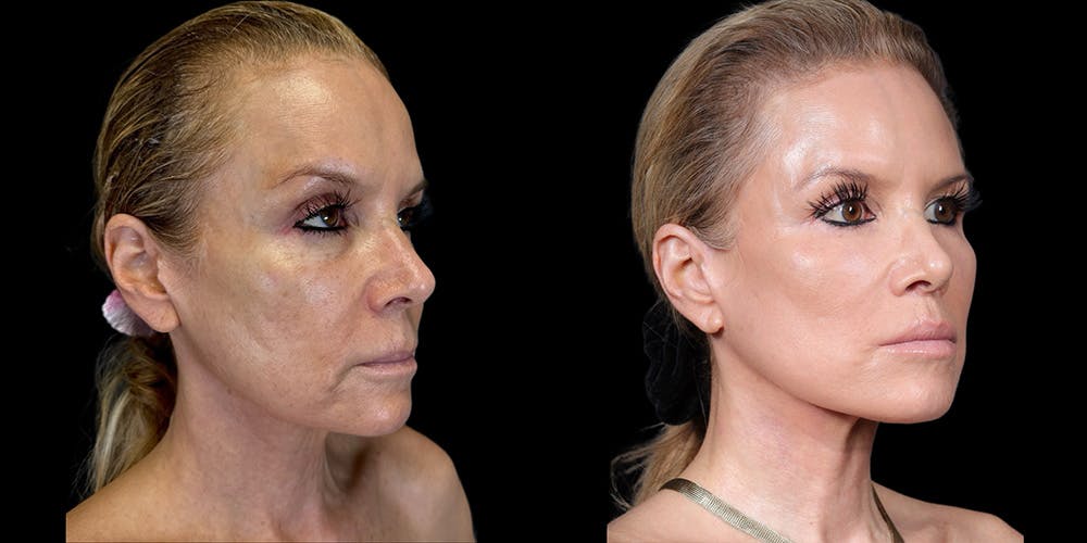 Fat Grafting Before & After Gallery - Patient 155766 - Image 2