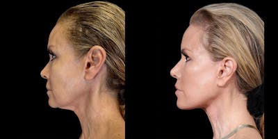 Necklift Before & After Gallery - Patient 138120 - Image 2