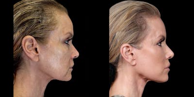 Neck Lift Before & After Gallery - Patient 138120 - Image 1
