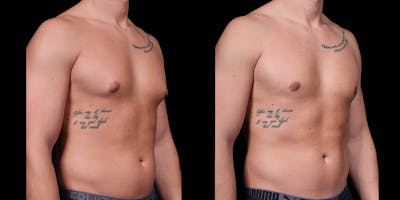 Gynecomastia Before & After Gallery - Patient 121439322 - Image 2