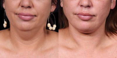 Neck Lift Before & After Gallery - Patient 818956 - Image 4