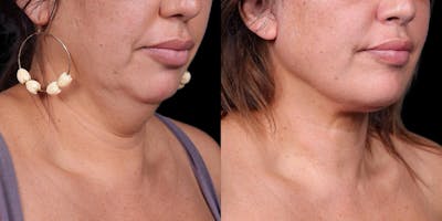 Necklift Before & After Gallery - Patient 818956 - Image 4