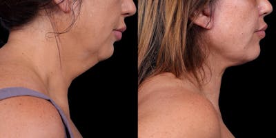 Neck Lift Before & After Gallery - Patient 818956 - Image 1