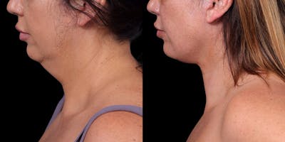 Necklift Before & After Gallery - Patient 818956 - Image 1