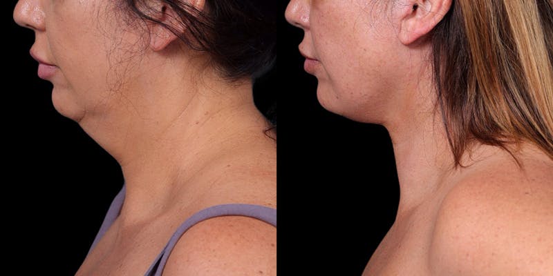Neck Lift