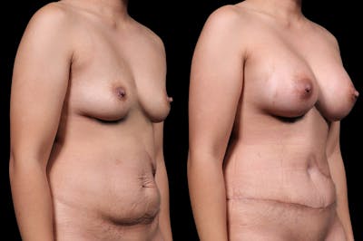 Mommy Makeover Before & After Gallery - Patient 148352120 - Image 2