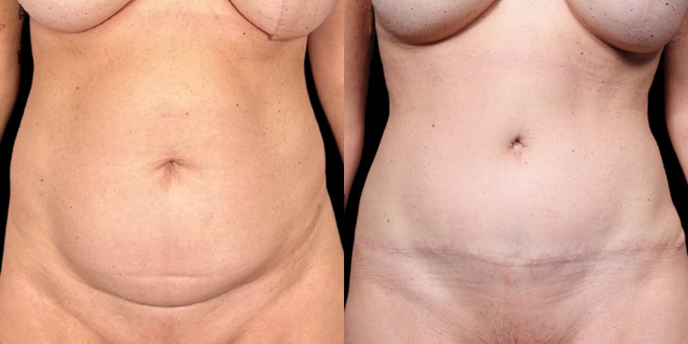 Tummy Tuck Before & After Gallery - Patient 354332 - Image 1