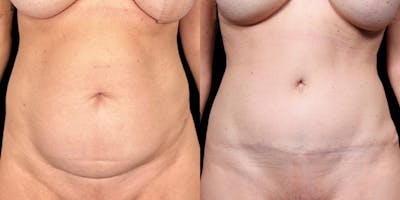 Tummy Tuck Before & After Gallery - Patient 354332 - Image 1