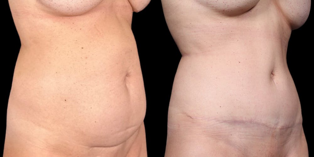 Tummy Tuck Before & After Gallery - Patient 354332 - Image 2