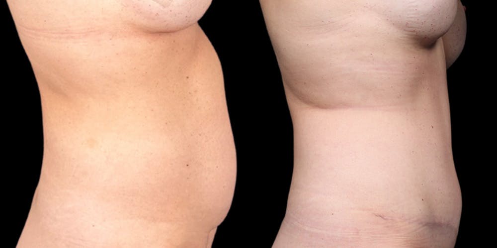 Tummy Tuck Before & After Gallery - Patient 354332 - Image 3
