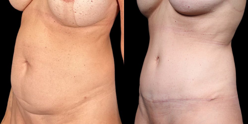 Tummy Tuck Before & After Gallery - Patient 354332 - Image 4