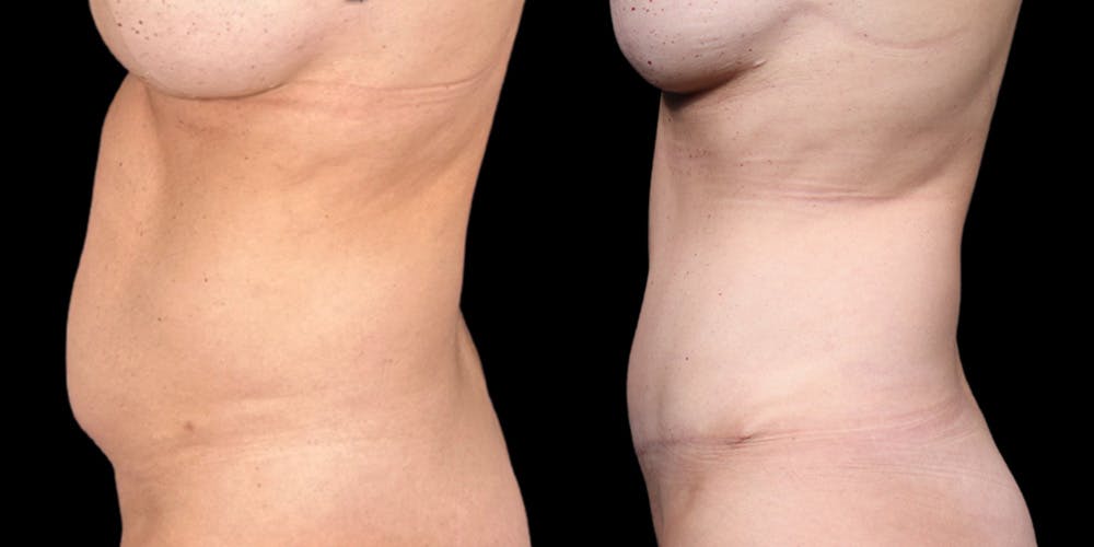 Tummy Tuck Before & After Gallery - Patient 354332 - Image 5