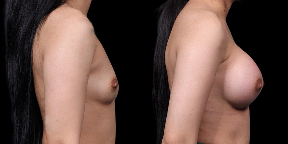Breast Augmentation Before & After Gallery - Patient 293183 - Image 3