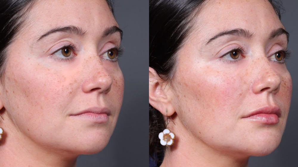BOTOX/Daxxify Before & After Gallery - Patient 804050 - Image 2