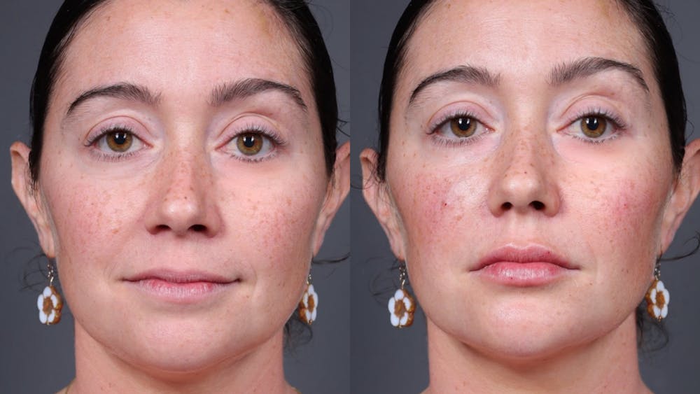 BOTOX/Daxxify Before & After Gallery - Patient 804050 - Image 1