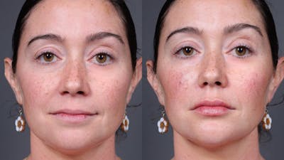 BOTOX/Daxxify Before & After Gallery - Patient 804050 - Image 1