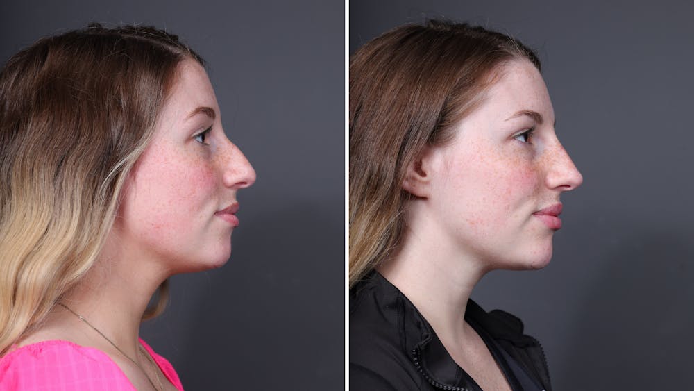 Facial Balancing Before & After Gallery - Patient 147562 - Image 1