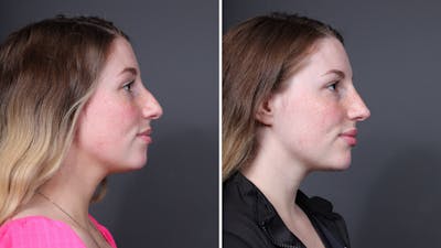 Facial Balancing Before & After Gallery - Patient 147562 - Image 1