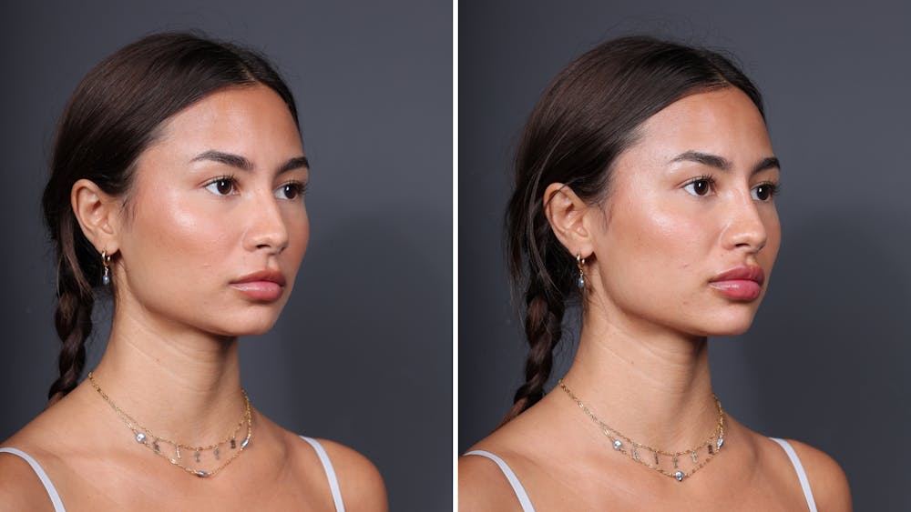 Lip Filler Before & After Gallery - Patient 195519 - Image 1