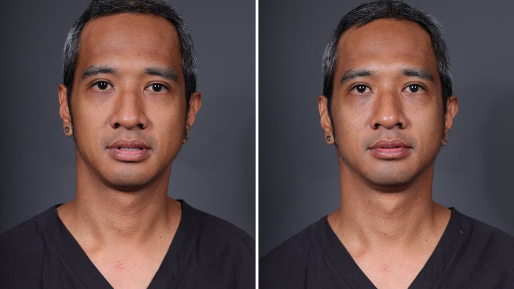 Facial Balancing Before & After Gallery - Patient 223360 - Image 1