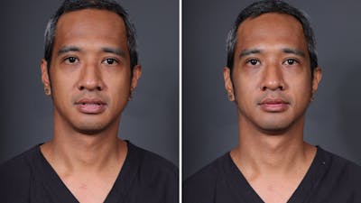 Facial Balancing Before & After Gallery - Patient 223360 - Image 1