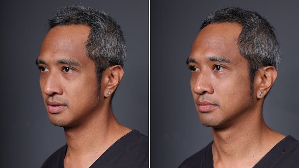 Facial Balancing Before & After Gallery - Patient 223360 - Image 2