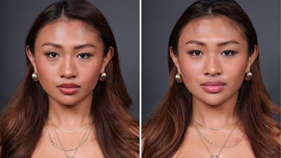 BOTOX/Daxxify Before & After Gallery - Patient 429606 - Image 1