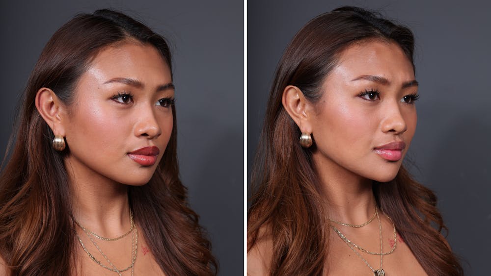 BOTOX/Daxxify Before & After Gallery - Patient 429606 - Image 2