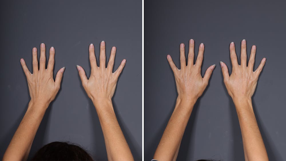 Dermal Fillers Before & After Gallery - Patient 144612 - Image 1