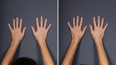 Dermal Fillers Before & After Gallery - Patient 144612 - Image 1