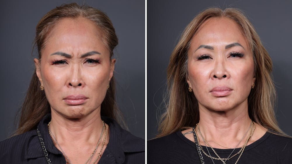 BOTOX/Daxxify Before & After Gallery - Patient 284496 - Image 1