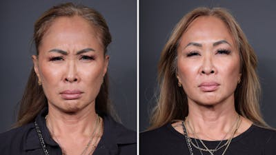 BOTOX/Daxxify Before & After Gallery - Patient 284496 - Image 1