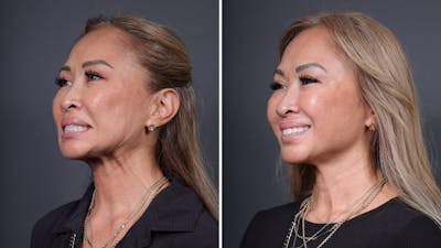 BOTOX/Daxxify Before & After Gallery - Patient 284496 - Image 2