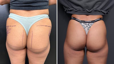 Non-Surgical BBL Before & After Gallery - Patient 116567 - Image 1