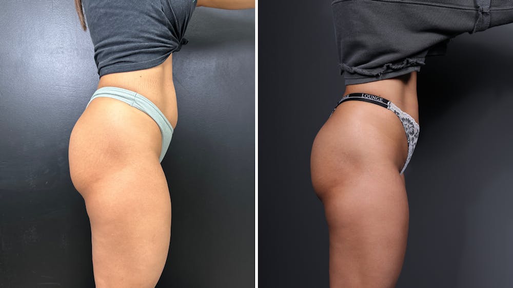 Non-Surgical BBL Before & After Gallery - Patient 116567 - Image 2