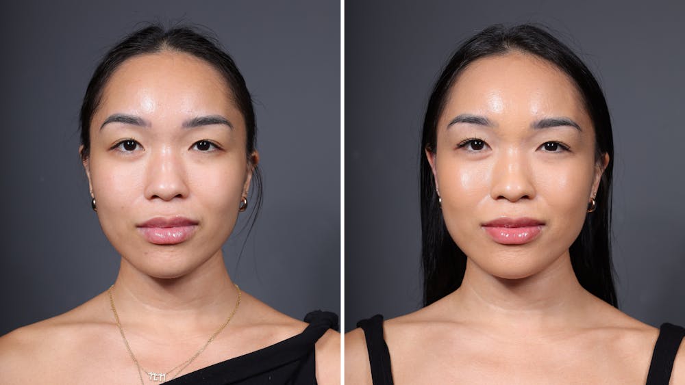 CoolPeel CO2 Laser Before & After Gallery - Patient 951177 - Image 1