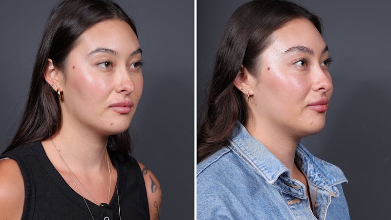 coolpeel co2 laser before & after