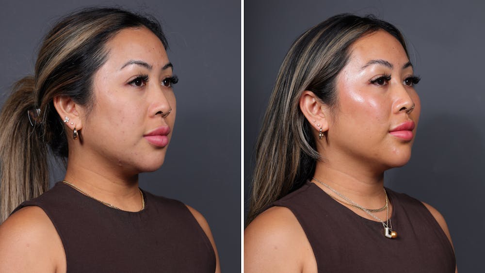 CoolPeel CO2 Laser Before & After Gallery - Patient 341351 - Image 1