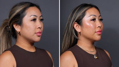 CoolPeel CO2 Laser Before & After Gallery - Patient 341351 - Image 1