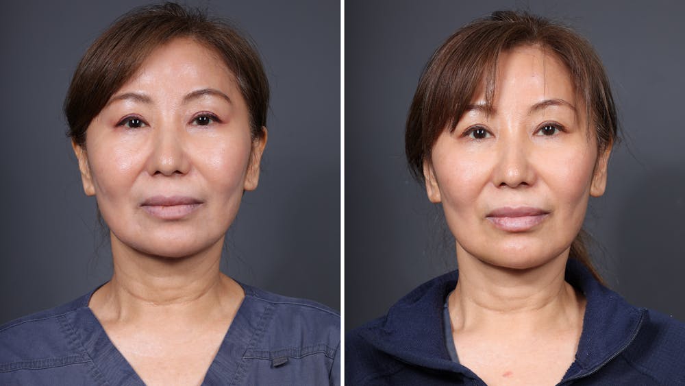 CoolPeel CO2 Laser Before & After Gallery - Patient 232020 - Image 1