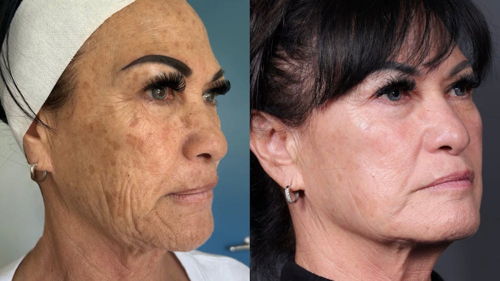 Chemical Peels Before & After Gallery - Patient 282333 - Image 1