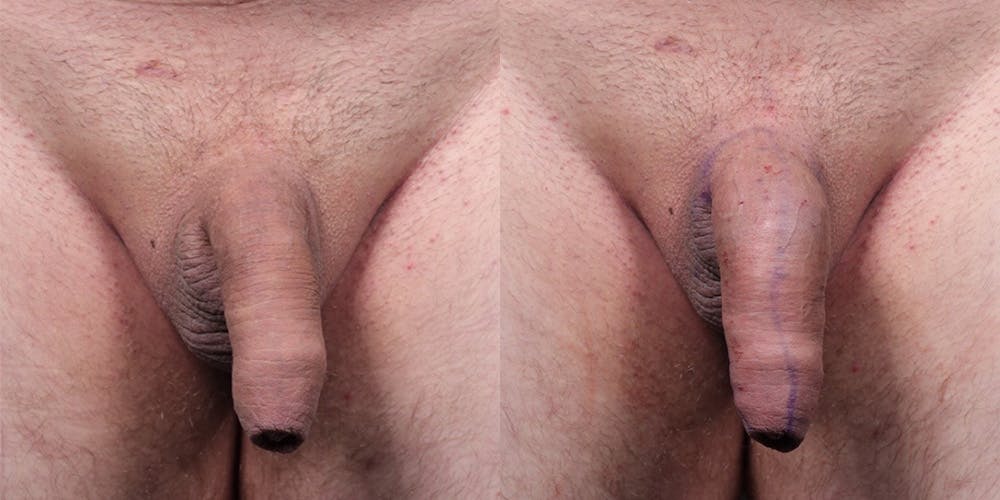 Penis Enhancement Before & After Gallery - Patient 292021 - Image 1